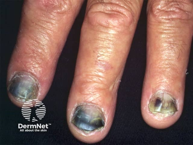 Black nails with pseudomonas infection