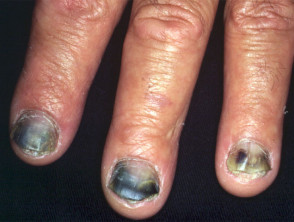 Black nails with pseudomonas infection
