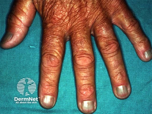 Blue nails due to minocycline
