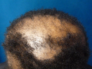 Central centrifugal cicatricial alopecia | DermNet