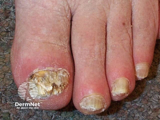 Fungal nail infection