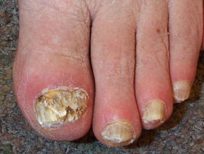 Nail dystrophy due to onychomycosis