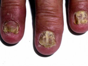 Nail dystrophy due to psoriasis