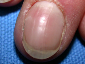 Overcurvature of nail