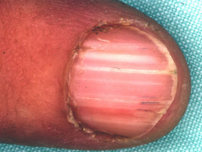 Darier nail disease