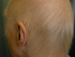 Alopecia from drugs | DermNet