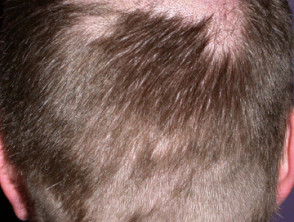 Alopecia from drugs | DermNet