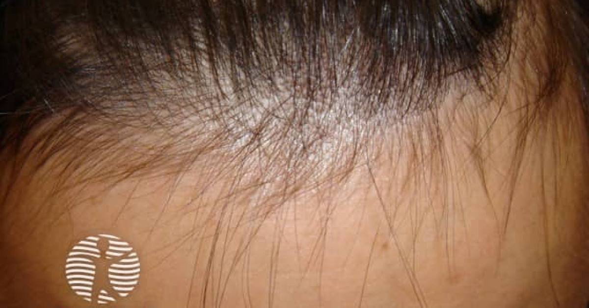 Alopecia from drugs image