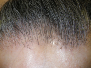 Fibrosing alopecia