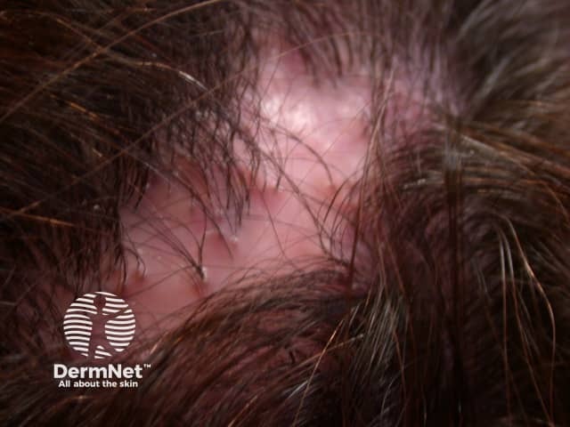 Tufted hairs and perifollicular erythema