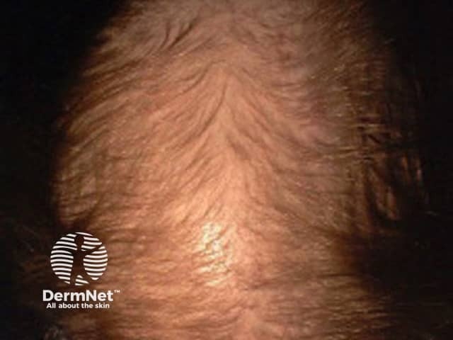 Female pattern alopecia. Credit Dr R Sinclair