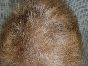 Defects of the hair shaft | DermNet
