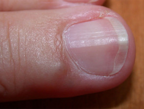 Nail groove due to myxoid cyst