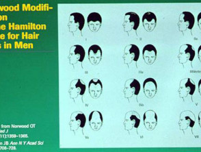 The Norwood classification of male pattern alopecia