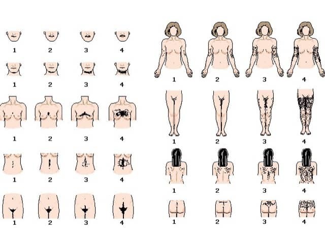 Ferriman-Gallwey visual scale for assessing hirsutism