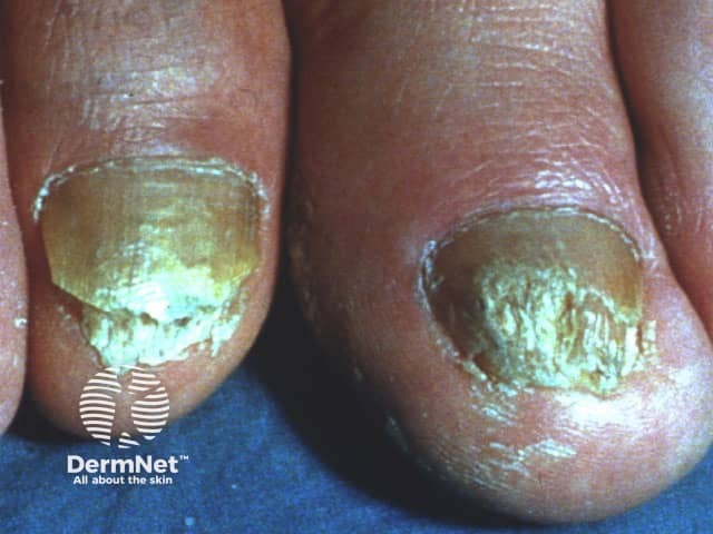 Nails in psoriasis