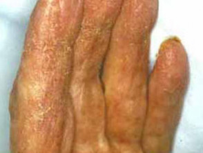 Crusted scabies with scaling under nails