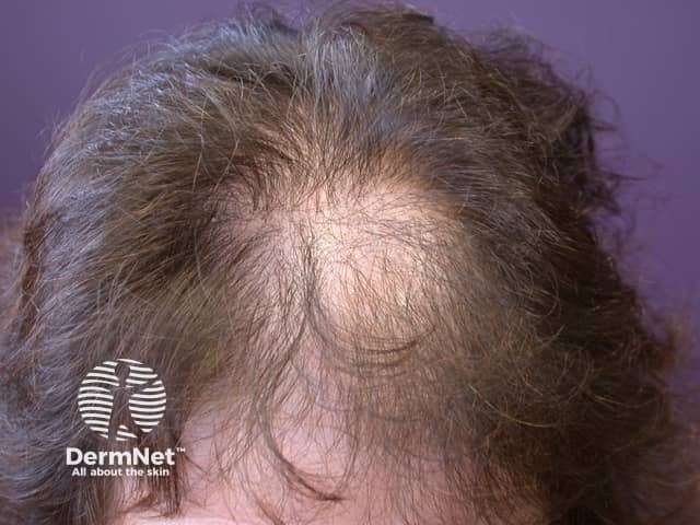 Pattern alopecia