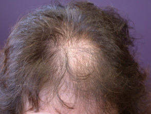 Female pattern alopecia