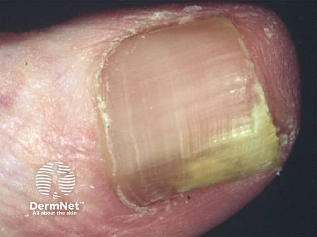 Due to dermatophyte onychomycosis