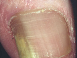 Fungal Nail Infections  DermNet