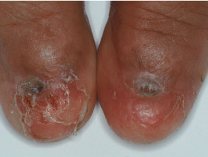 Nail loss due to lichen planus