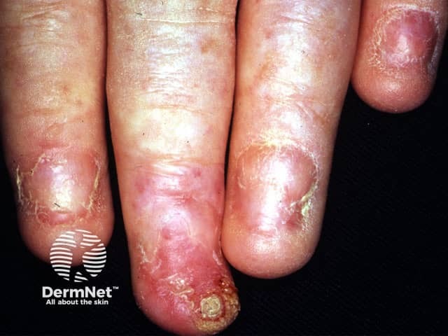 Nail shedding due to lichen planus