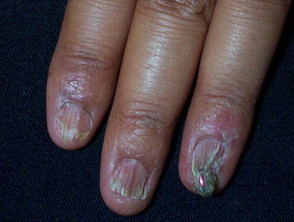 Lichen planus of nails