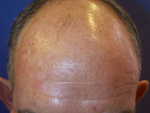 Male balding