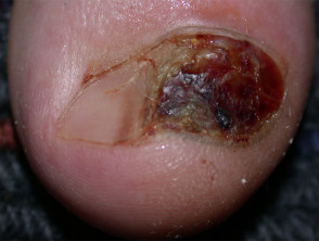 Melanoma of nail