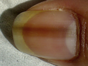 Dark lines on nails  MDedge Family Medicine