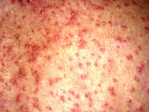 Heat Rash or Prickly Heat (Miliaria Rubra) Condition, Treatments and  Pictures for Infants - Skinsight