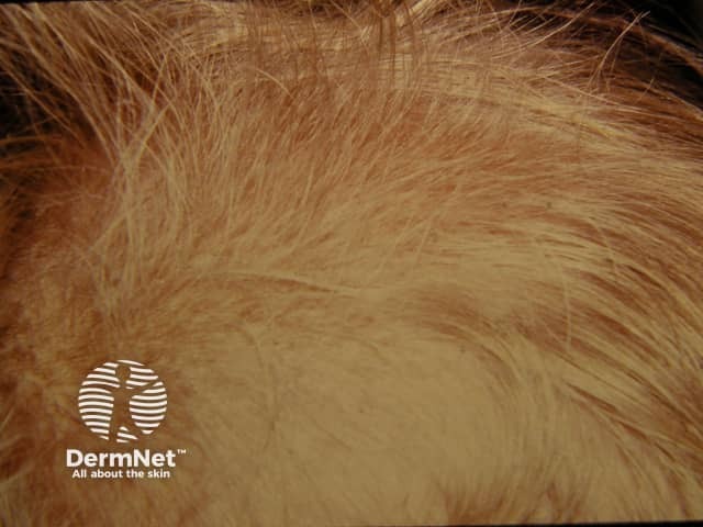 Beaded hair or monilethrix