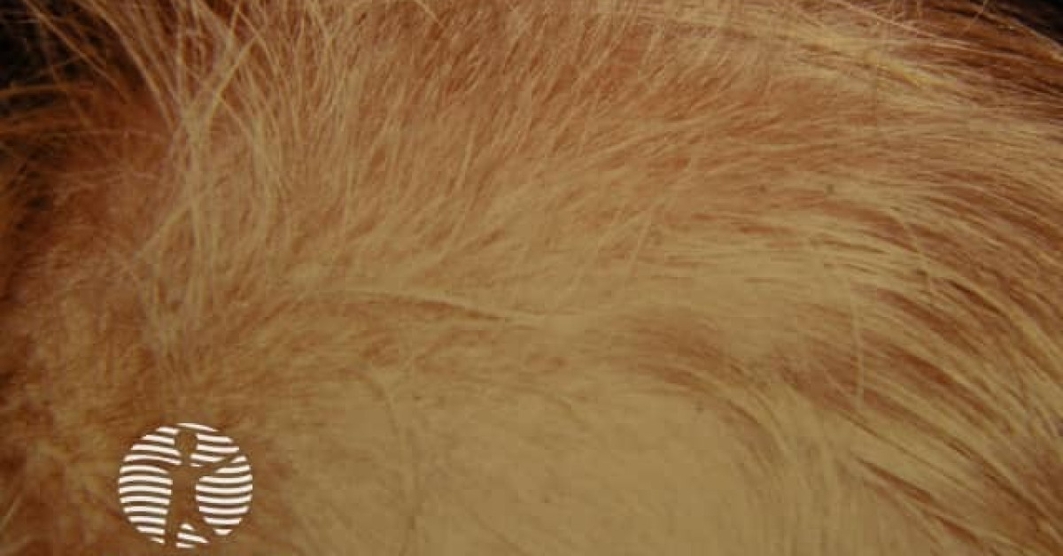 Beaded hair or monilethrix image