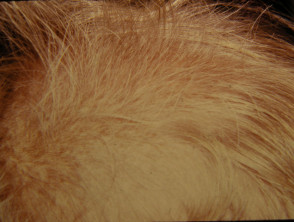 Beaded hair or monilethrix