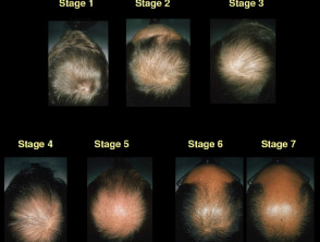 Sinclair classification of male pattern alopecia
