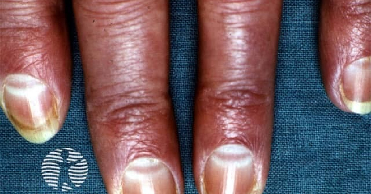 Muehrcke Nail Image