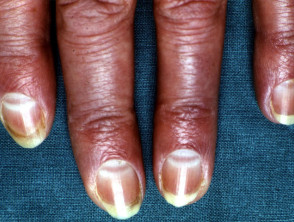 Muehrcke nail