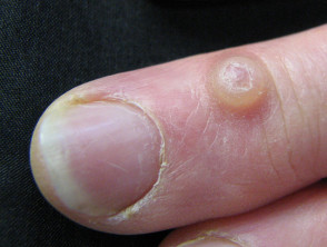 Cutaneous Cysts And Pseudocysts Dermnet Nz