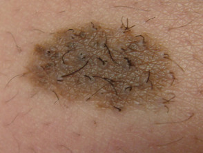 congenital nevus melanoma