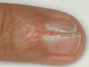 Nail splitting due to lichen planus