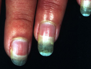 causes translucent nails