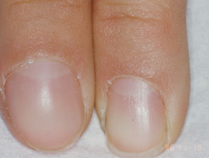 Nail enlargement due to osteoma