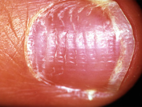 Surgical Correction of Severe Bilateral Thumb PincerNail Deformity