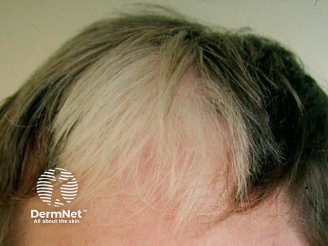 White patch of hair syndrome