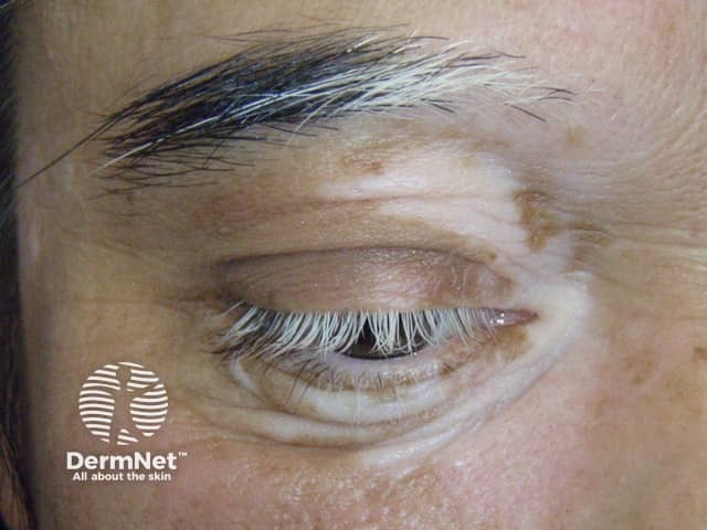 Poliosis of eyebrow and eyelashes in vitiligo
