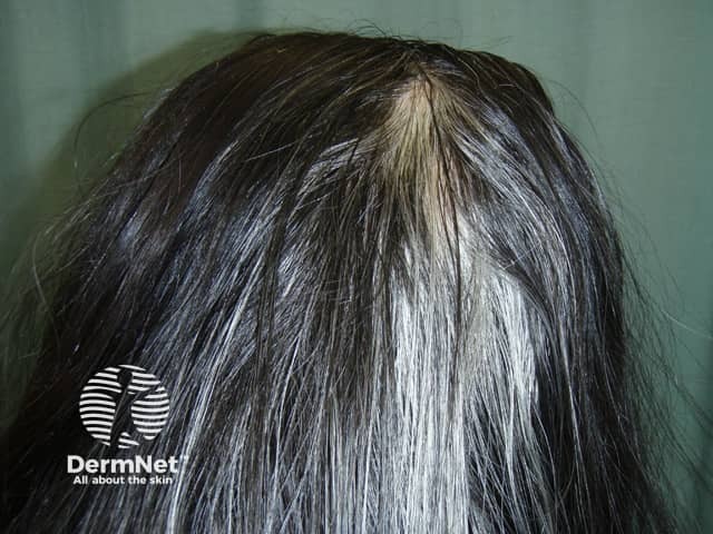 Poliosis due to halo naevus