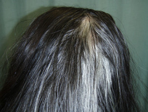 Poliosis in halo naevus
