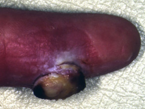 Periungual pyogenic granuloma