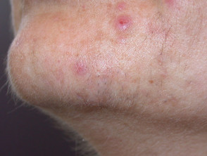 Folliculitis due to hair removal